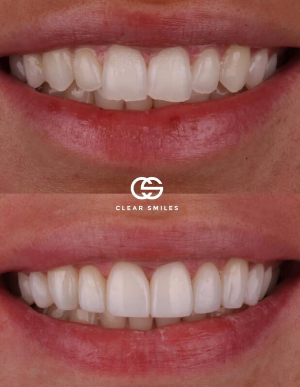 Gallery - Clear Smiles